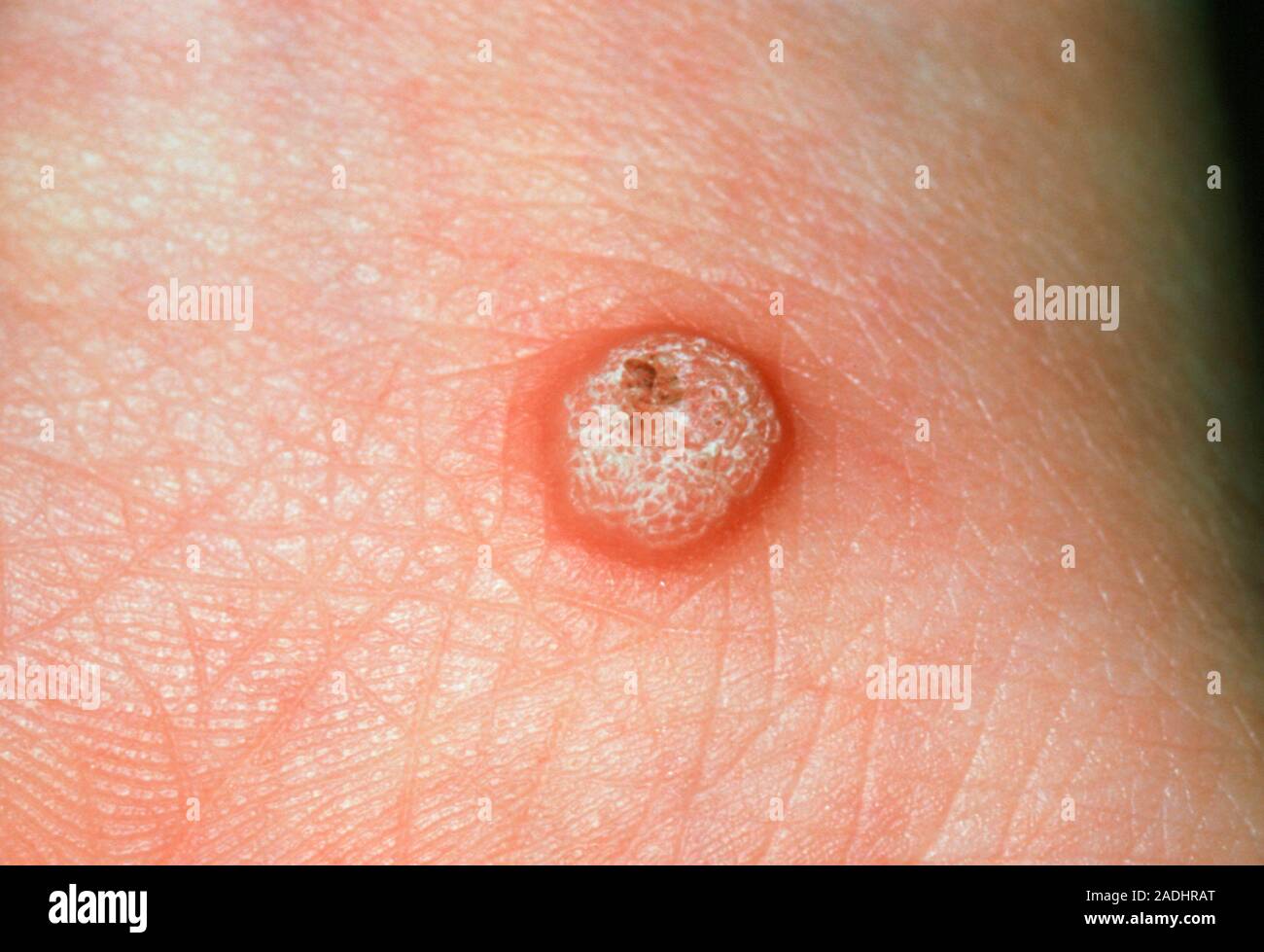 Close-up showing a wart, also known as verruca. Warts are hard, rough ...