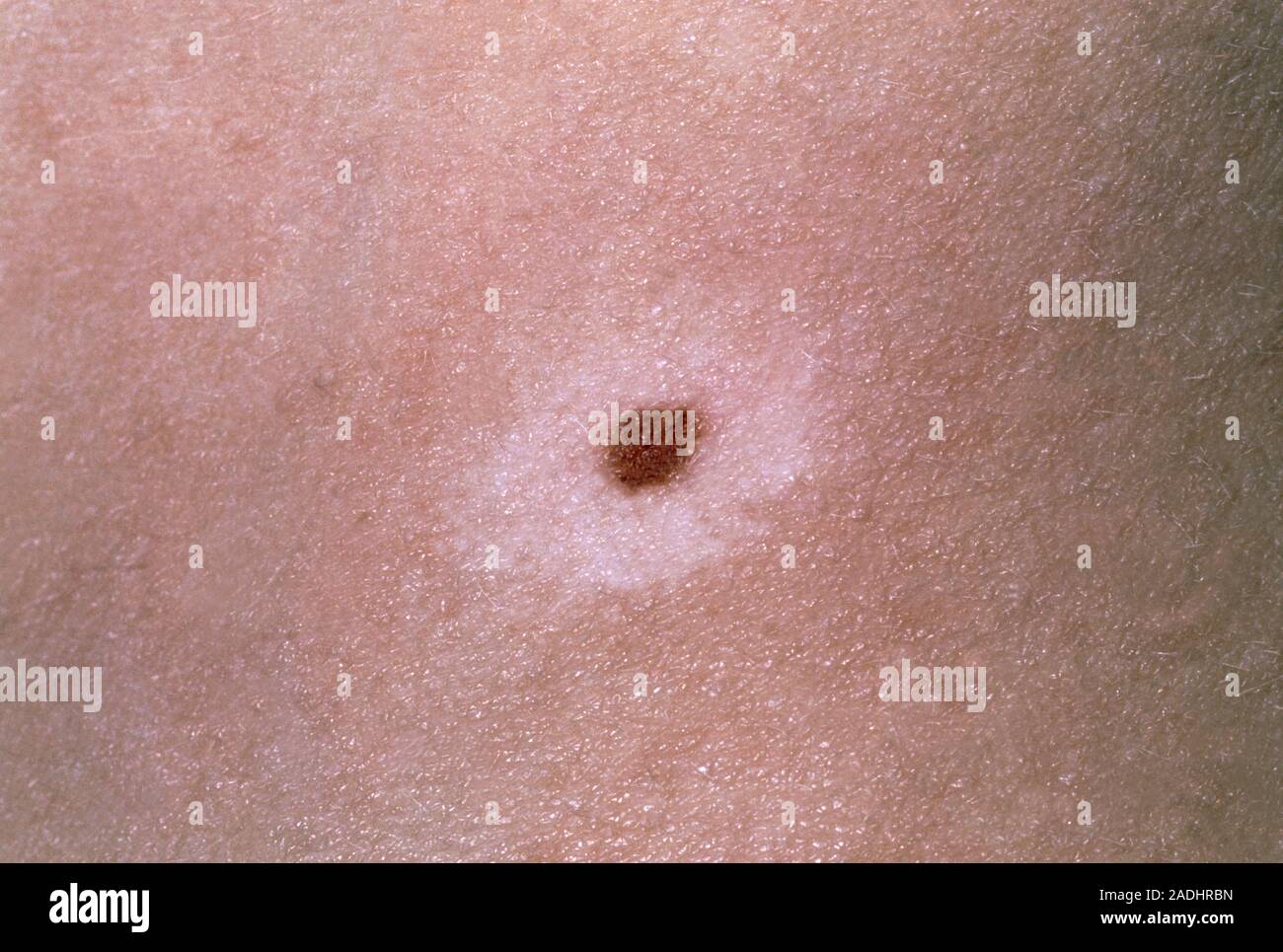 Patchy Color Vitiligo. Vitiligo is a common disorder of the skin in which patches of ...