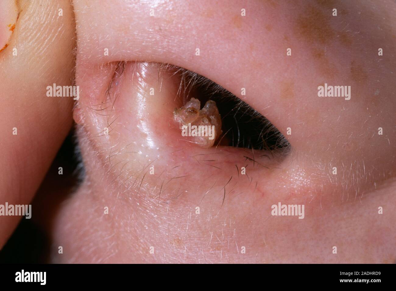 Nine Months Post-Rhinoplasty to Correct Dorsal Hump and Nasal Tip Before  and After - Philip Miller MD, image size:1300x955