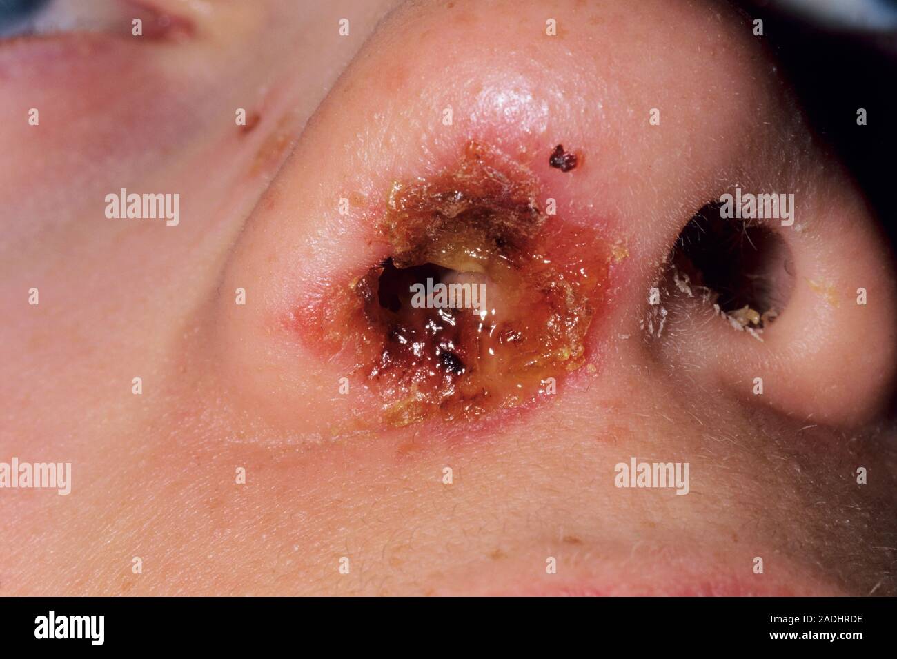 Nose infection. Close up of the nose of a 12 year old boy showing bleeding and pus caused by vestibulitis a bacterial infection of the nostril. This Stock Photo Alamy