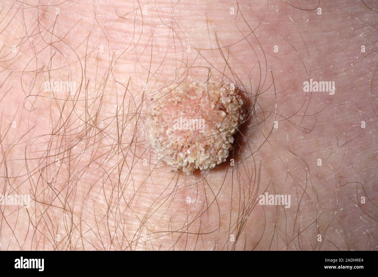 Wart (verruca vulgaris) on a 73yearold man's knee. Warts are harmless, contagious growths of