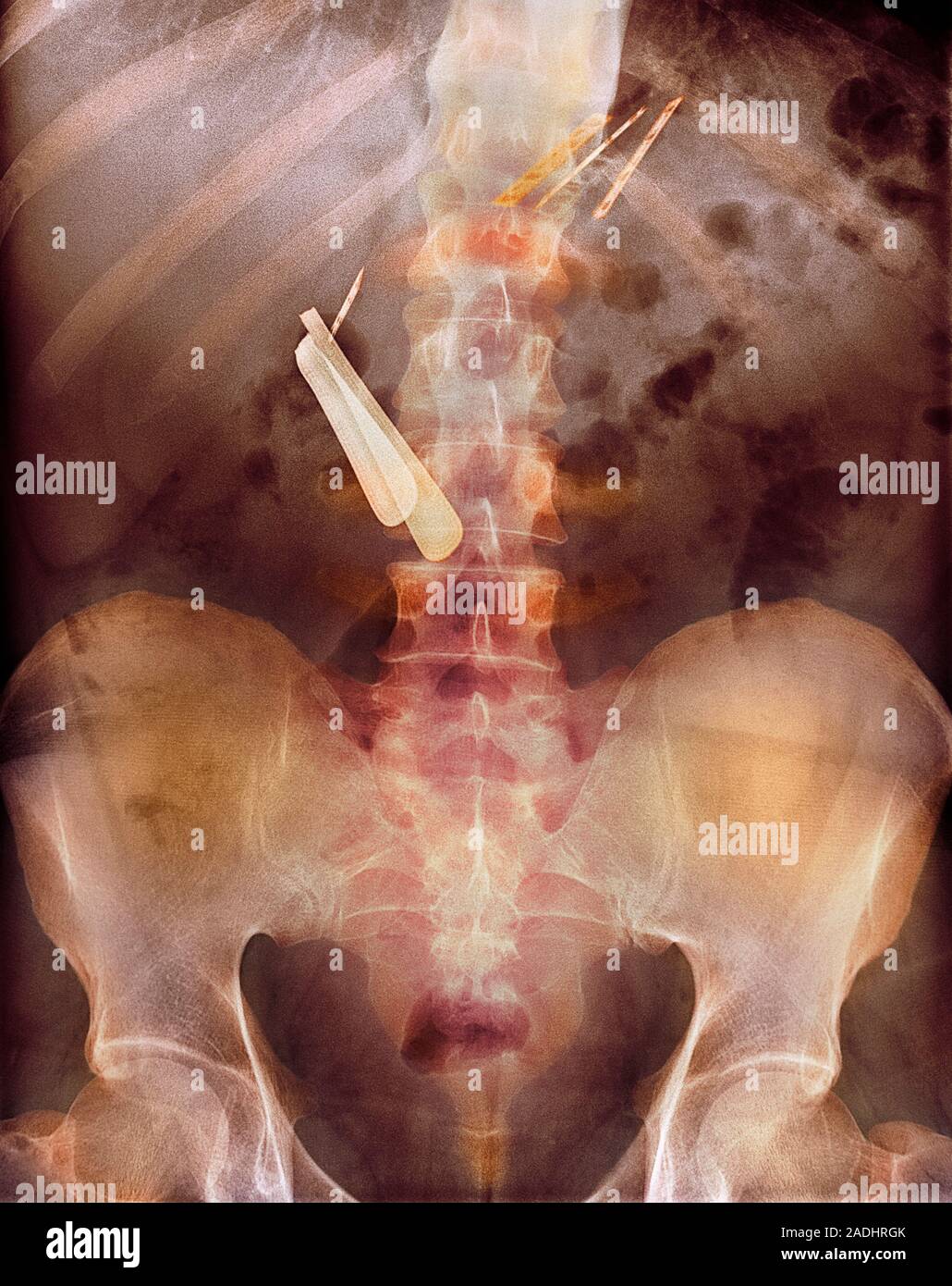 Swallowed razor and razor blades. Coloured X-ray of the abdomen of a ...