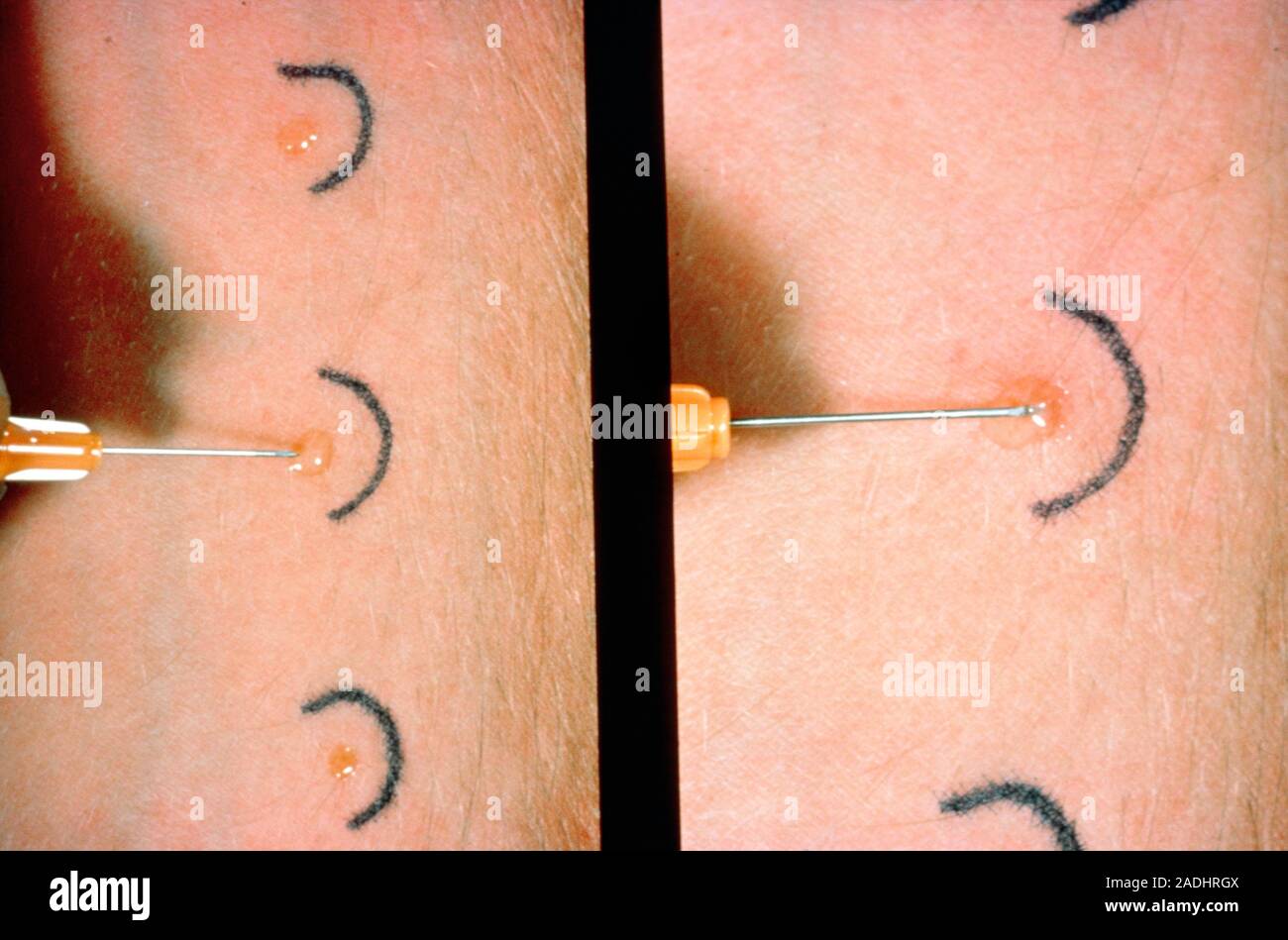 Allergy skin tests for asthma, showing hypodermic syringe used to
