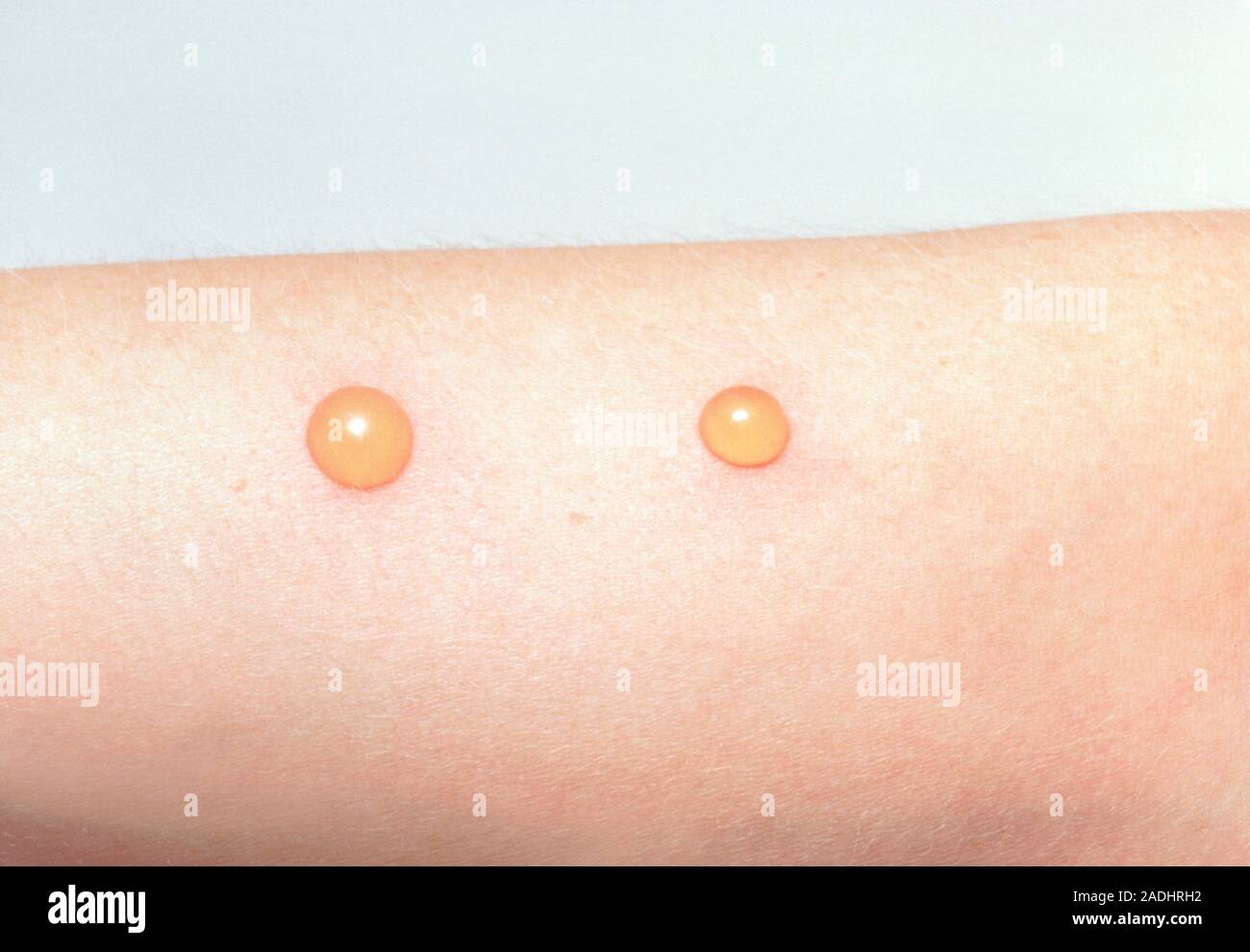 Picture of Two large blisters of the skin due to cat flea bites Stock Photo - Alamy
