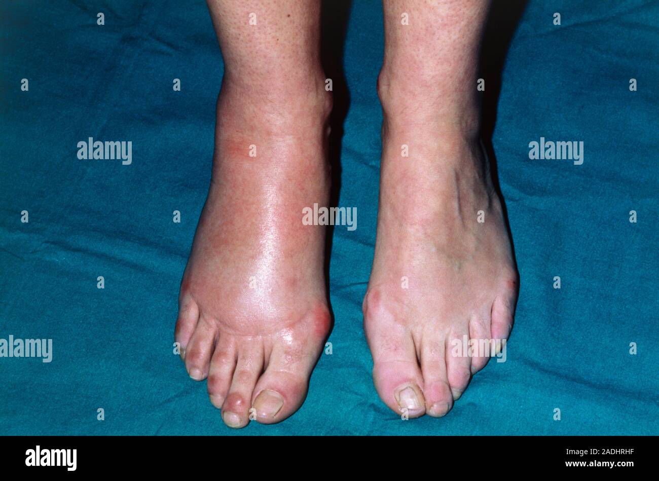 Swollen, oedematous right foot, following an insect bite. The normal