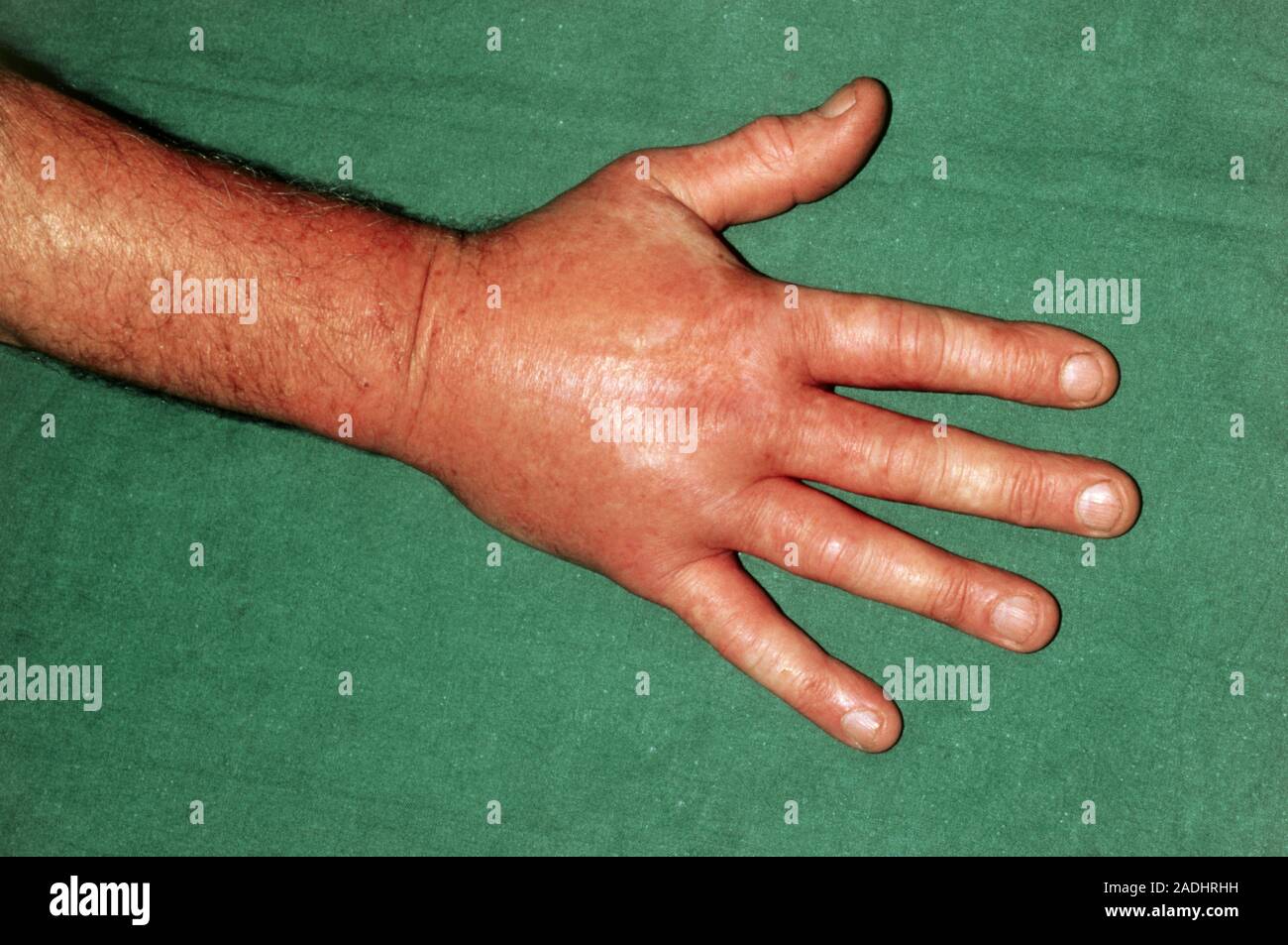 Oedema (accumulation of fluid) in the tissues of the hand following an ...