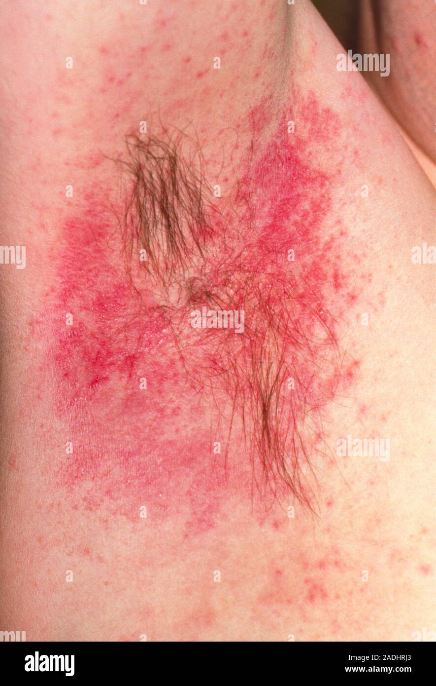 Hypersensitivity reaction to deodorant. View of a red rash (erythema ...