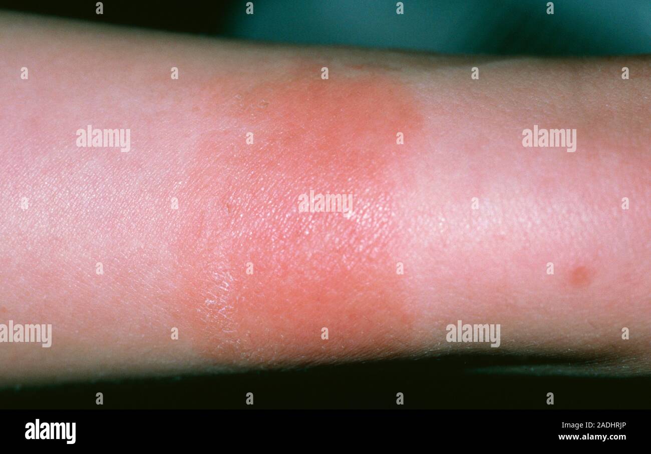 Dermatitis due to wristwatch allergy. A red rash around a patient's