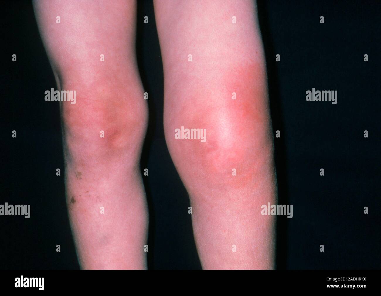 Wasp sting on the knee. Swollen knee (at right) due to a wasp sting