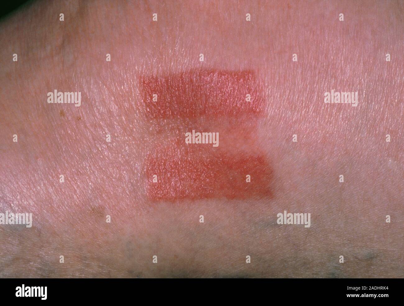 Elastoplast allergy. Rectangular pink skin rashes on a patient's skin