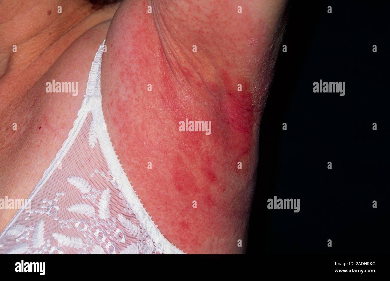 Allergic reaction to deodorant. A red rash in the armpit of a 65-year ...