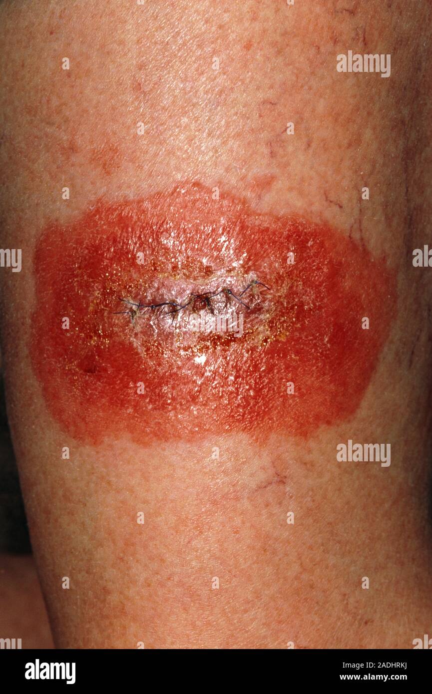 Allergy to dressing. Rectangular pink rash seen on the skin of a 71