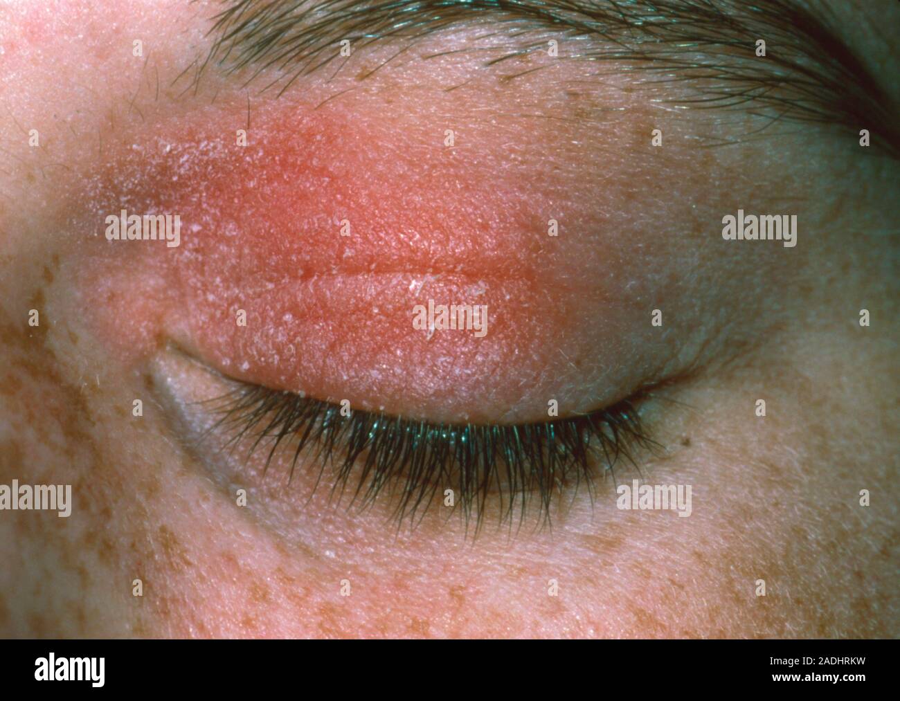 Allergic reaction to eye cosmetic. A red rash on the eyelids of a