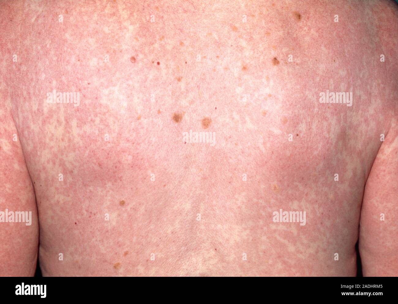 Carbamazepine allergy. Extensive rash over the back and arms of a 74 ...