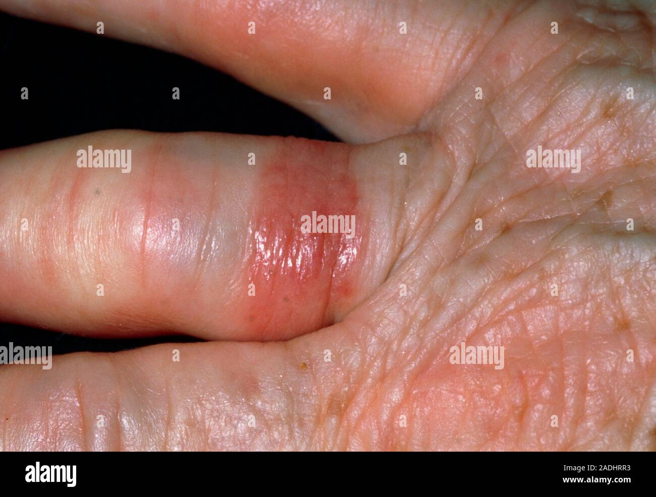Ring allergy. Red inflamed area around the finger of a 67 year old
