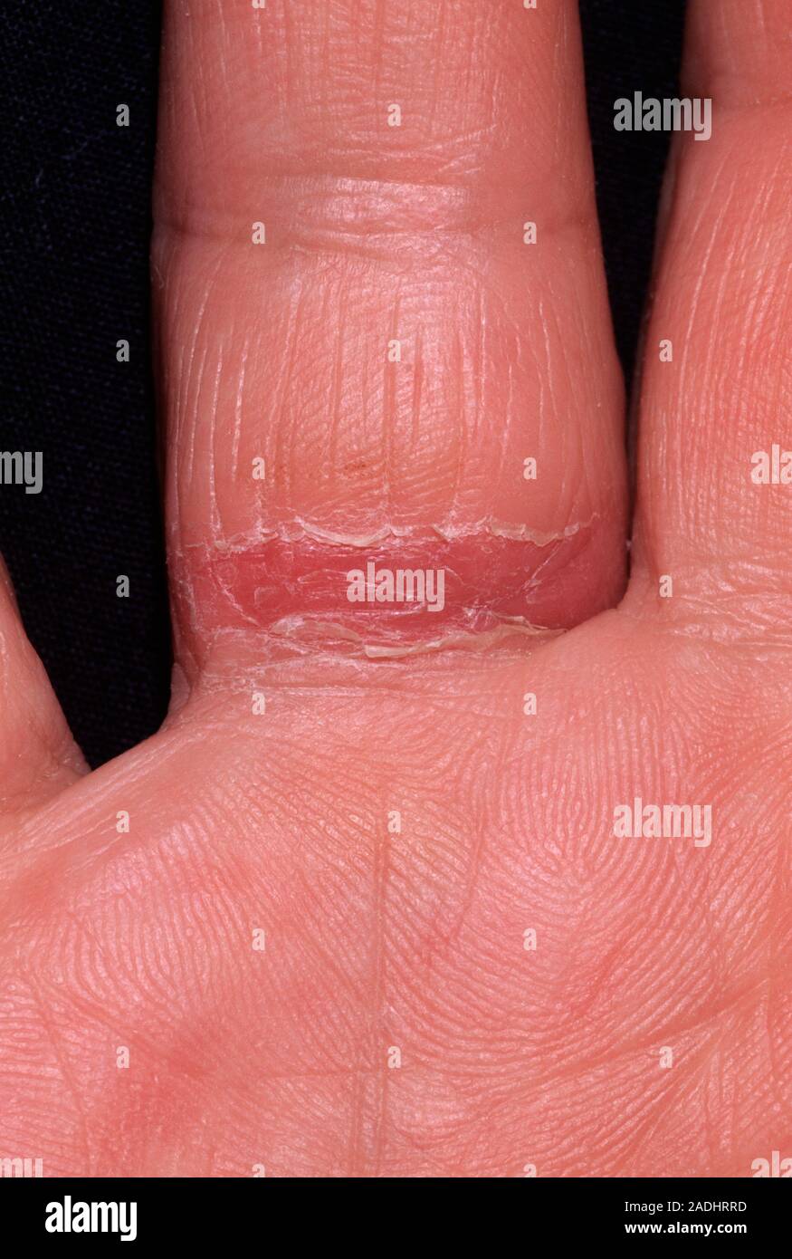Ring allergy. Red inflamed area around the finger of a 60yearold