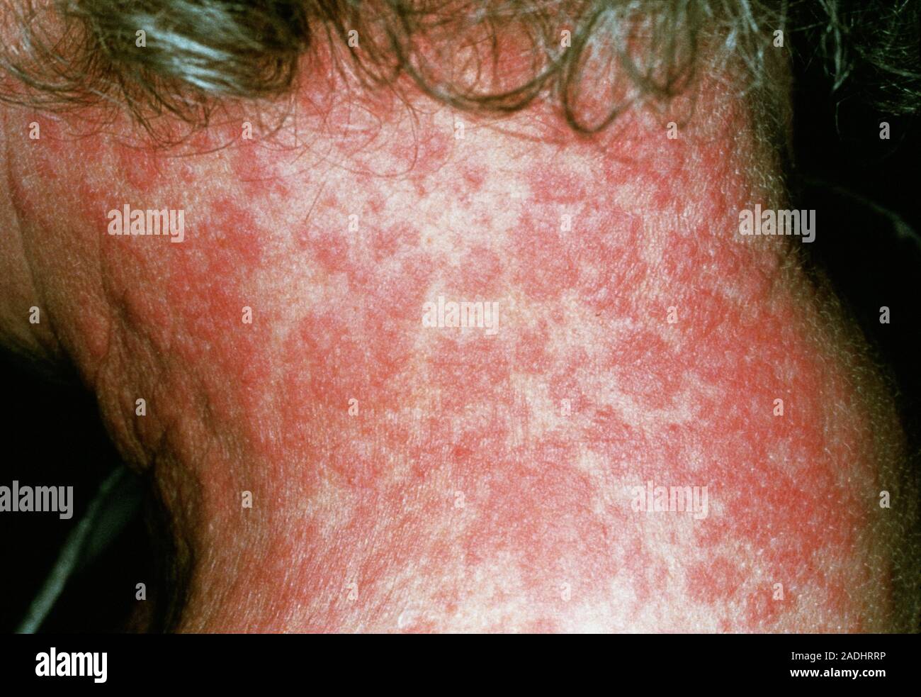 Allergic drug reaction. Skin rash on the neck of a patient suffering an