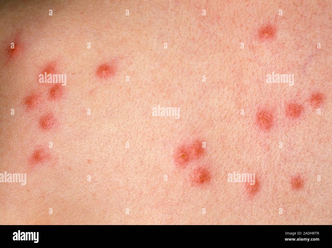Flea Bite Marks On The Skin Of A 5 Year Old Girl These Marks Papules
