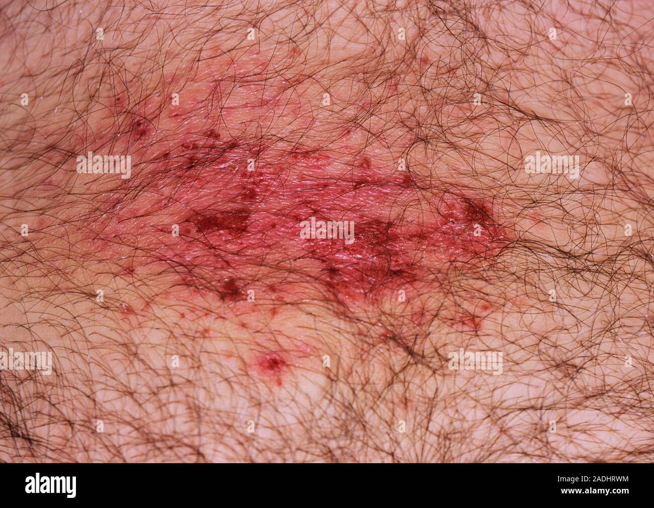 Allergic contact dermatitis (ACD). Inflamed and itchy rash around a 20yearold man's abdomen