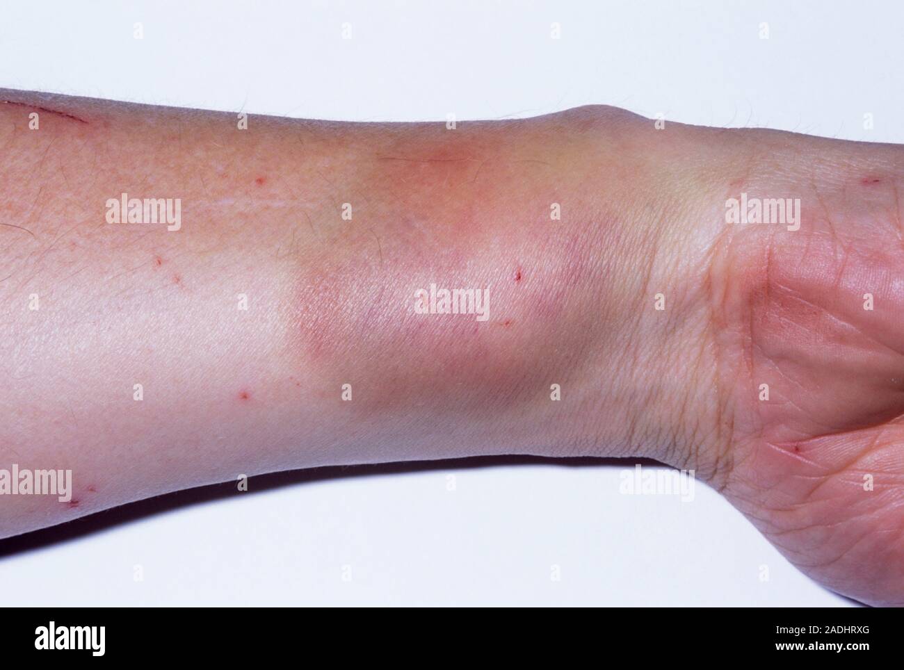 Plant injury, day 1. Image 1 of 3. Patient with puncture wounds