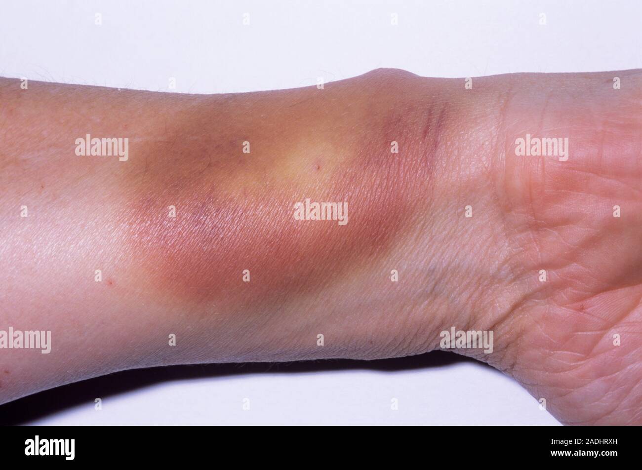 Plant injury, day 3. Image 3 of 3. Patient with puncture wounds