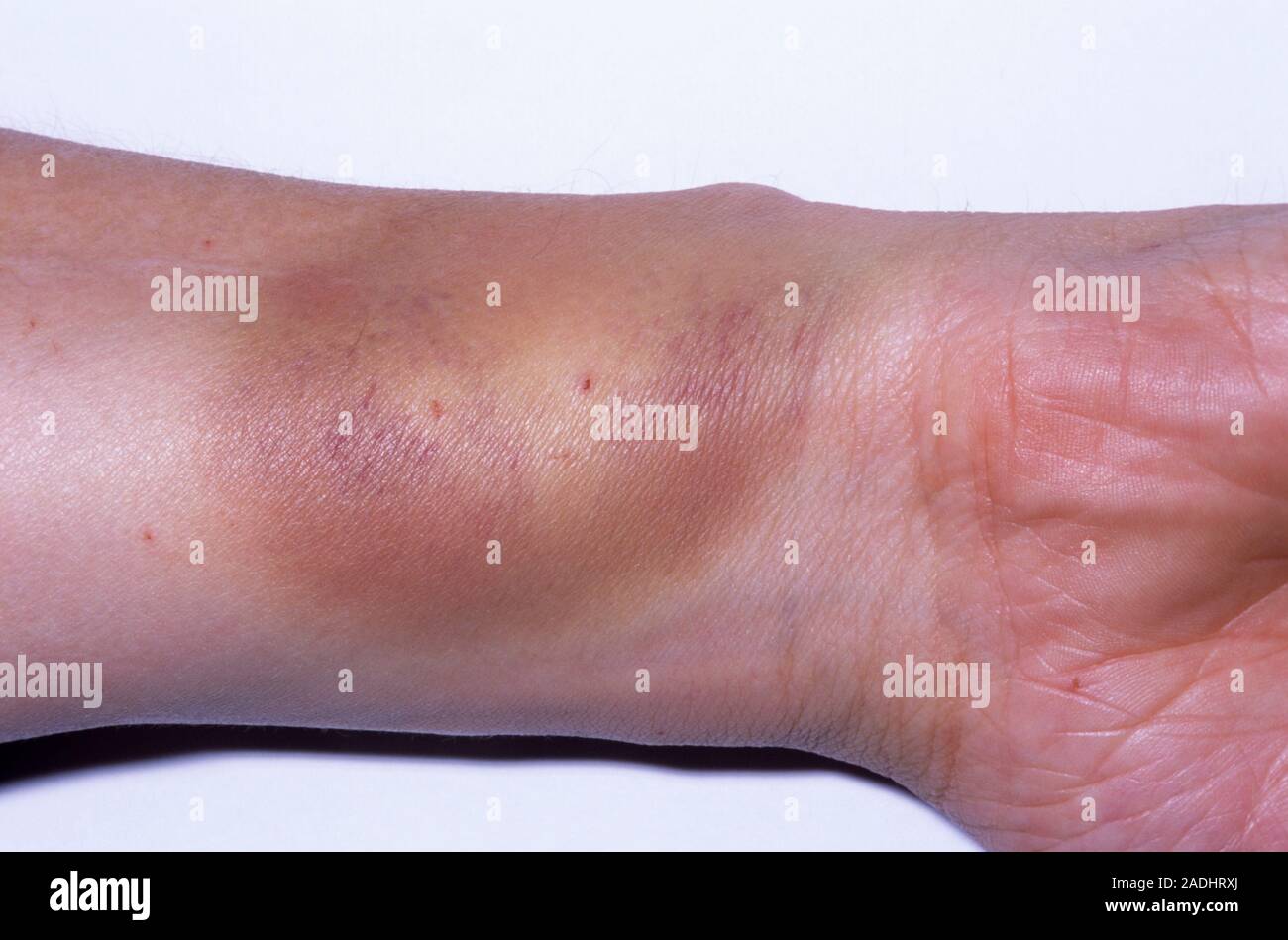 Plant injury, day 2. Image 2 of 3. Patient with puncture wounds