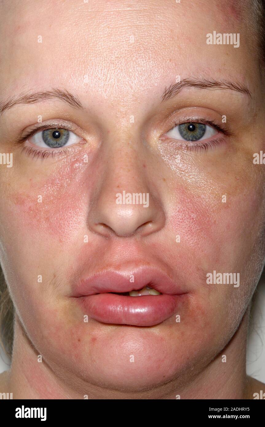 MODEL RELEASED. Swollen lips of a 32 year old woman caused by