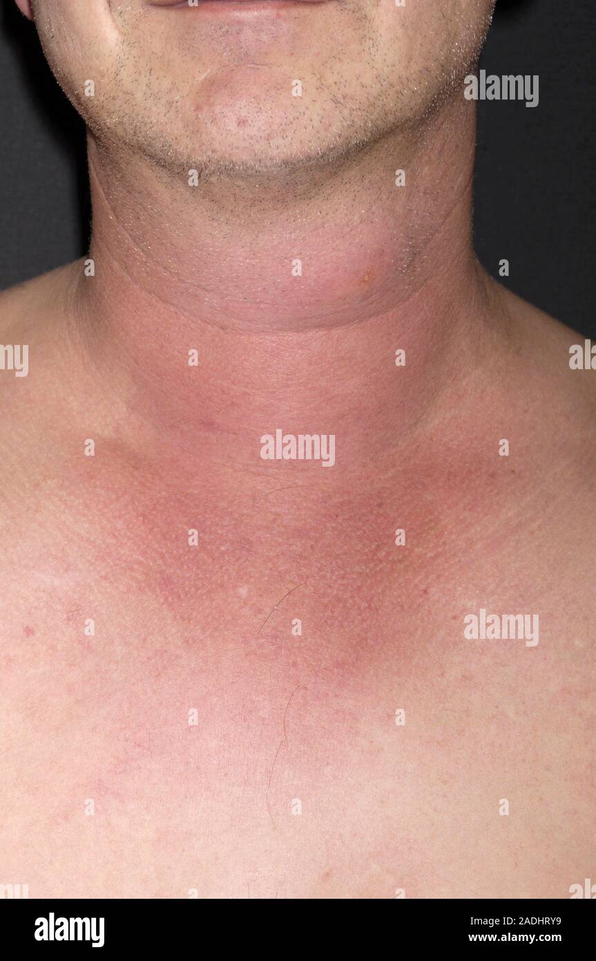 Insect bite allergy. Allergic reaction to an insect bite on the neck of ...