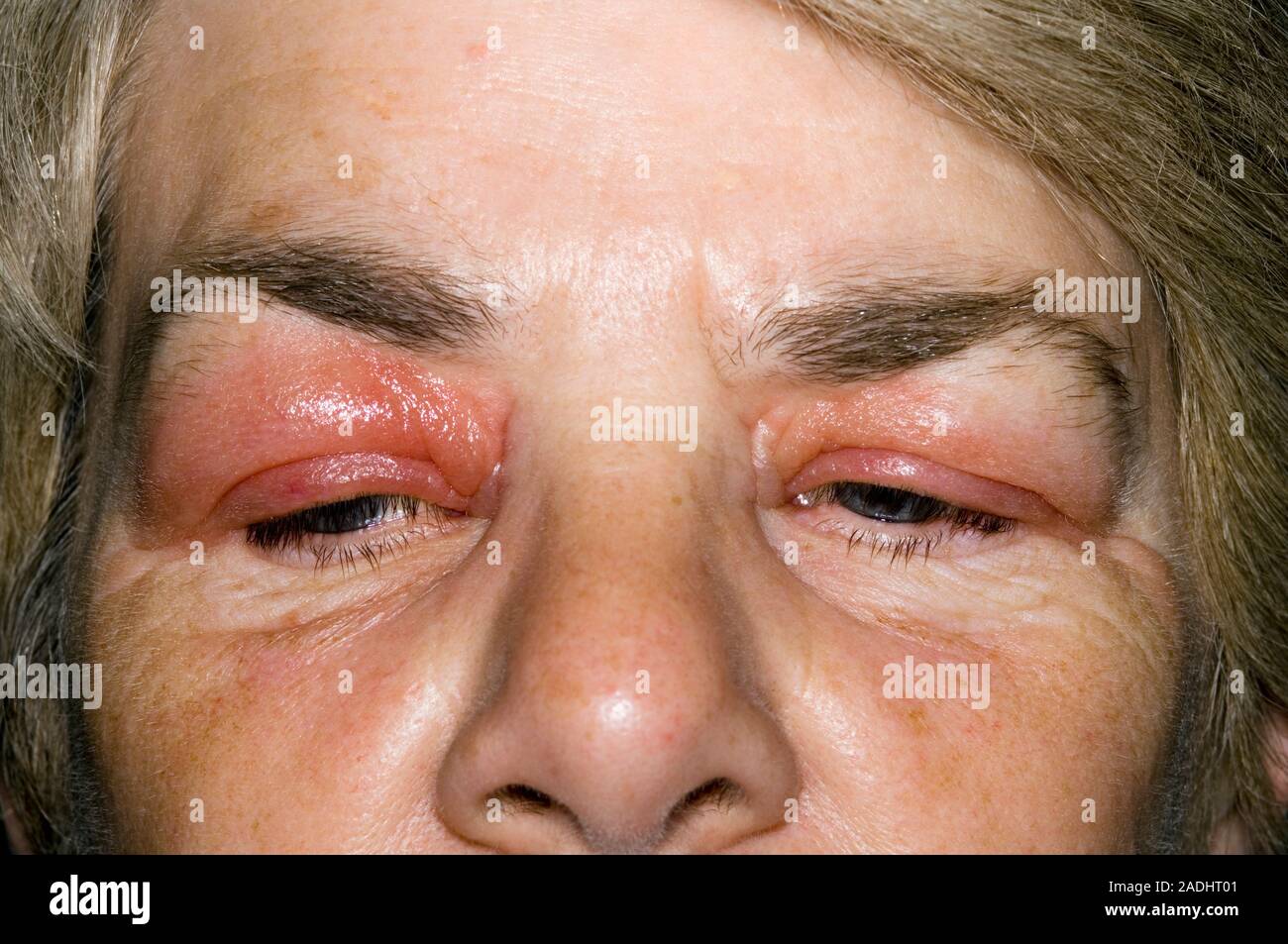 Swollen eyelids of a 58 year old woman. This is an allergic reaction