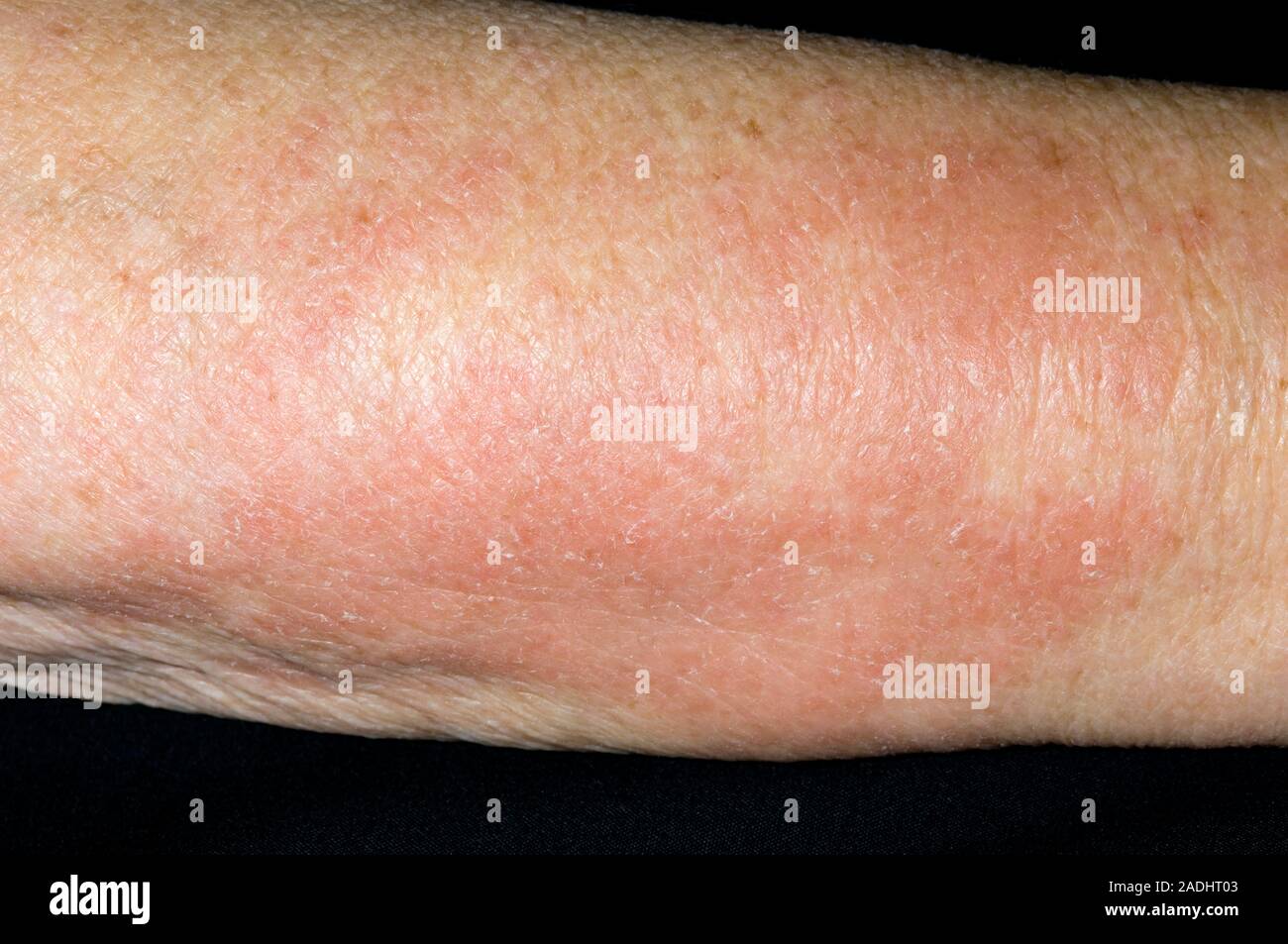 Allergic rash on the arm of a 79 year old woman. This response was