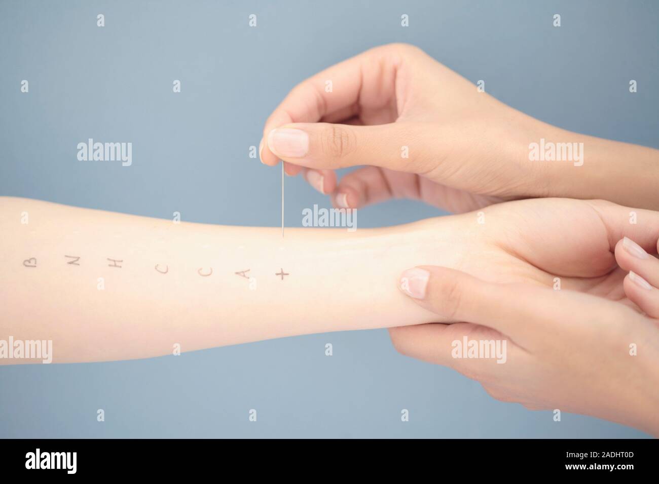 MODEL RELEASED. Allergy test. Arm of a twenty five year old woman