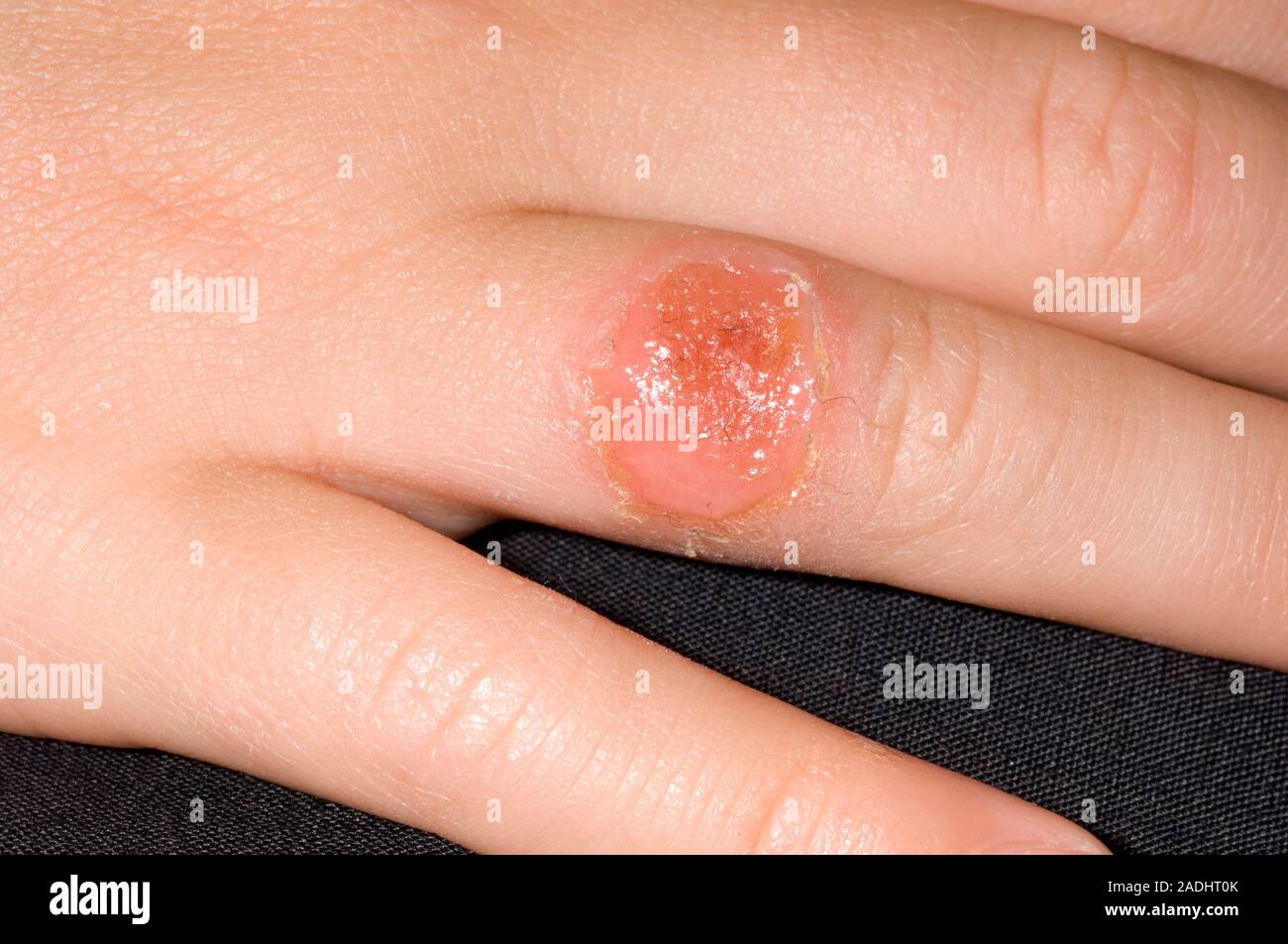 MODEL RELEASED. Infected insect bite on a 5 year old boy's finger. The