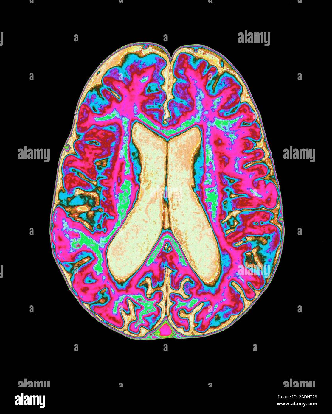 Organophosphate brain damage. Coloured magnetic resonance imaging (MRI ...