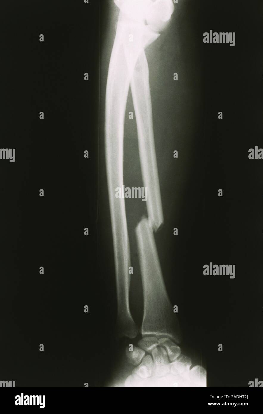 Xray of the right forearm showing a clean fracture of the radius, the shorter, outside bone of