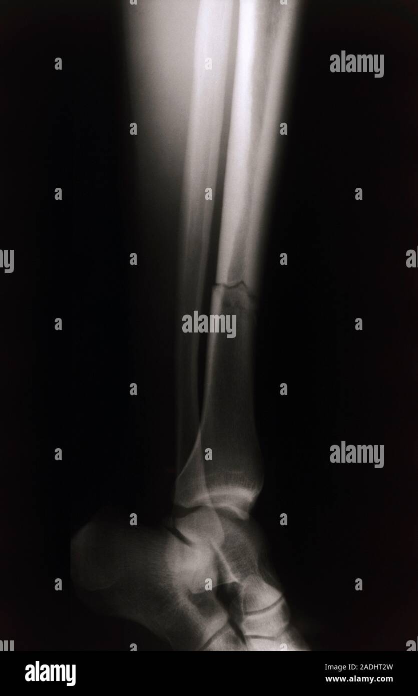 X-ray of the lower leg bones, the tibia (larger) & fibula (thinner ...