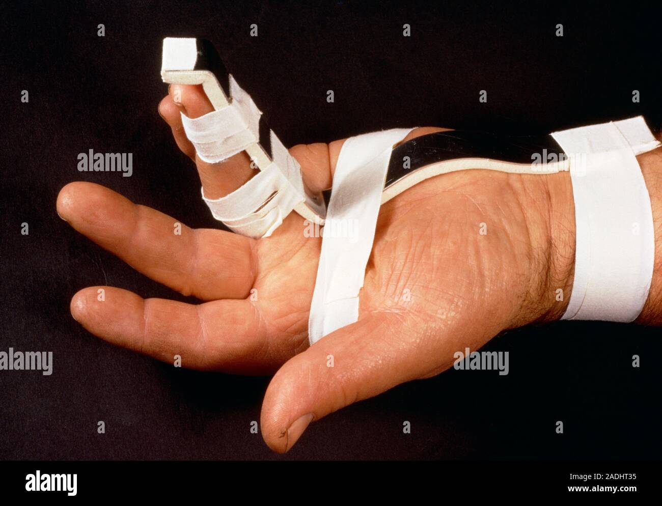Splint on a broken finger Stock Photo Alamy