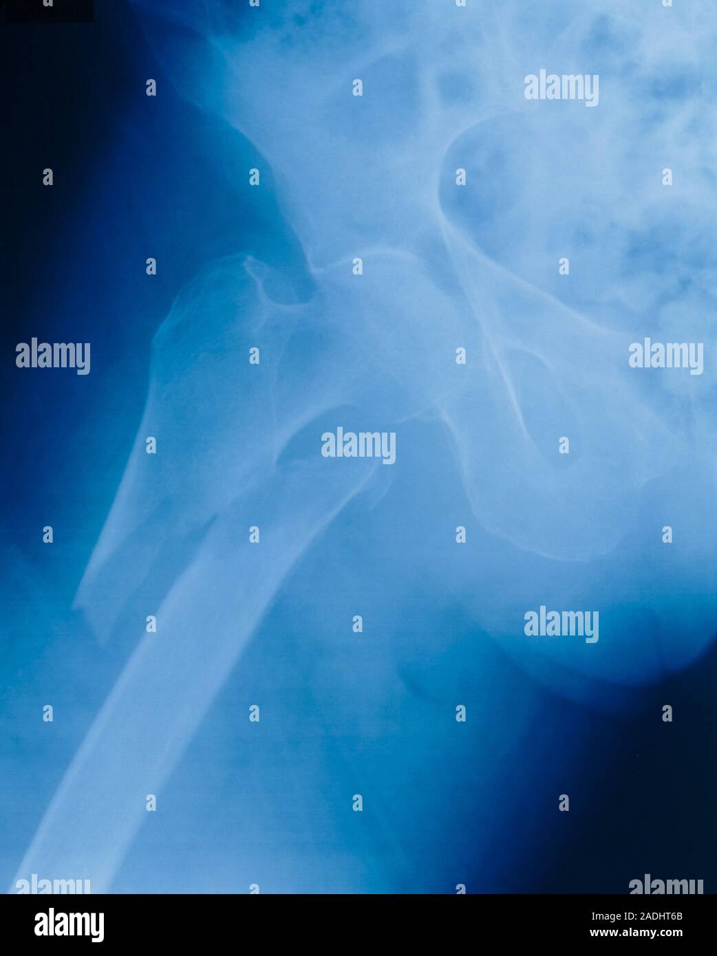 Hip fracture Xray image revealing a fracture of the neck of the right