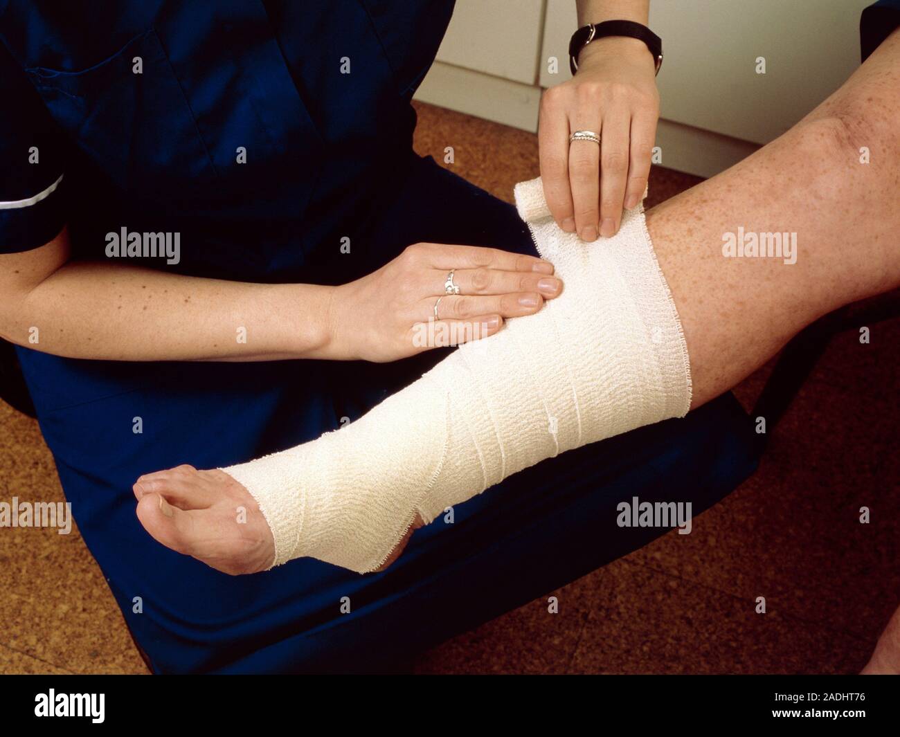 Nurse applying a bandage to a sprained ankle. A sprain is an injury to