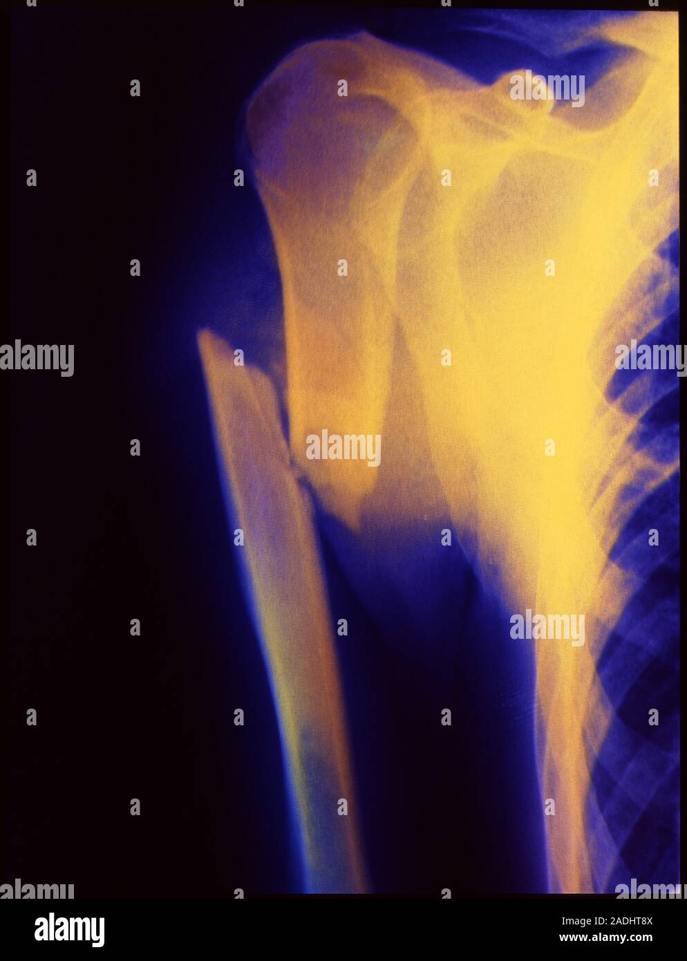 Broken upper armbone. Coloured Xray image showing a severe compound