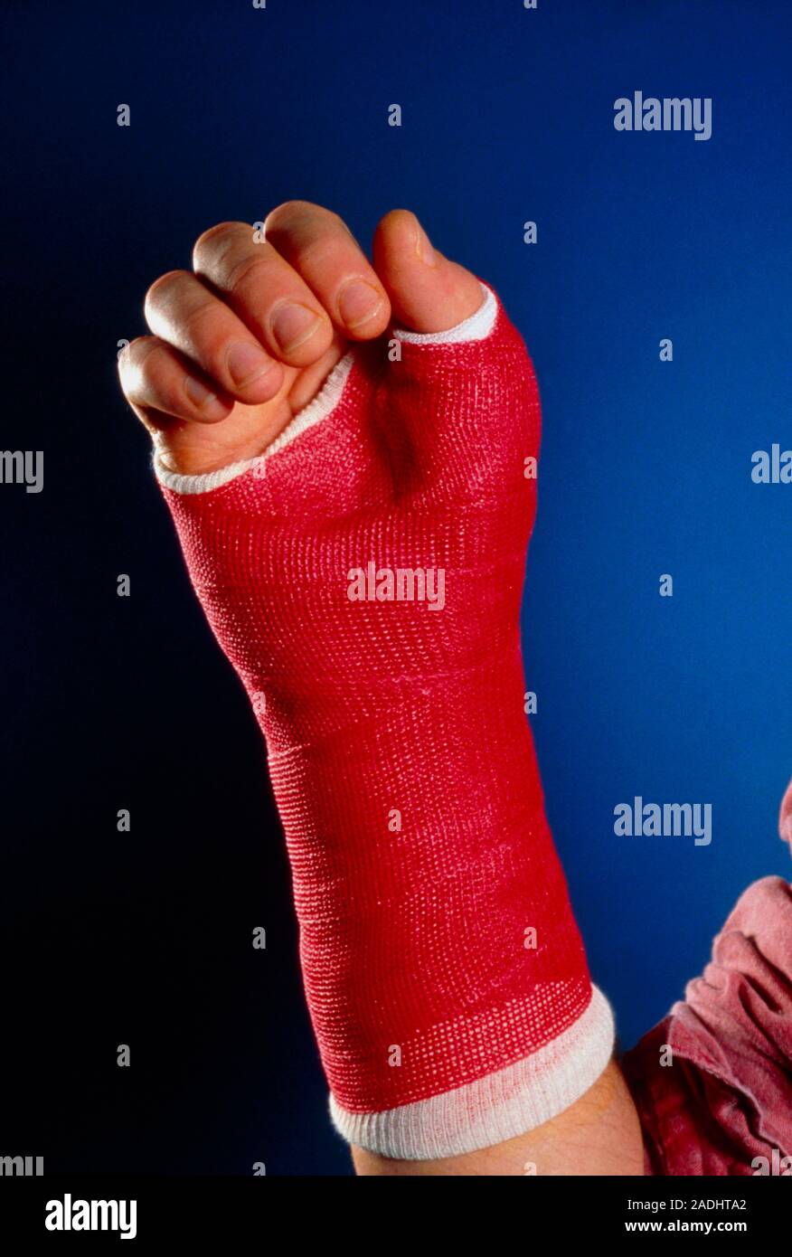 Fibreglass cast. Patient's injured wrist bandaged with a fibreglass