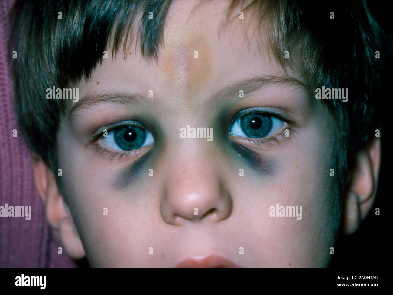 Fractured nose. The face of a young boy with black eyes and a bruised