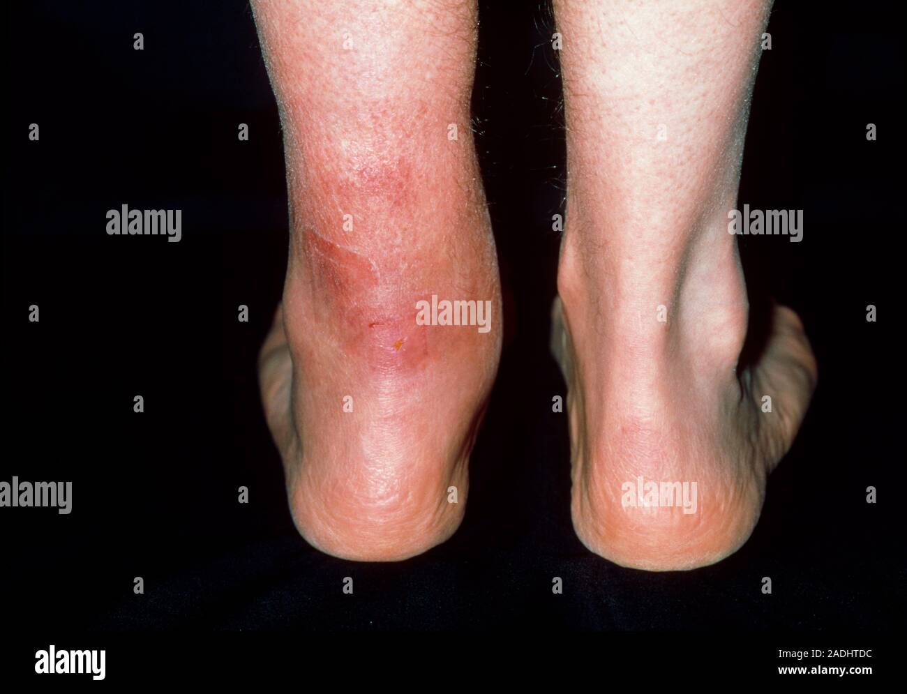 achilles-tendinitis-swollen-achilles-tendon-seen-on-the-left-leg-of-a