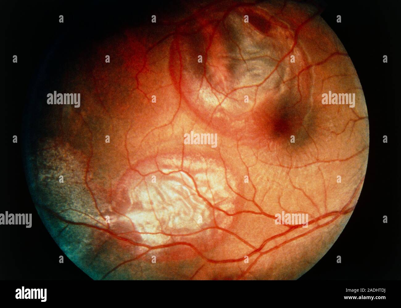 Cricket ball injury to eye. Ophthalmoscope view of the injured retina
