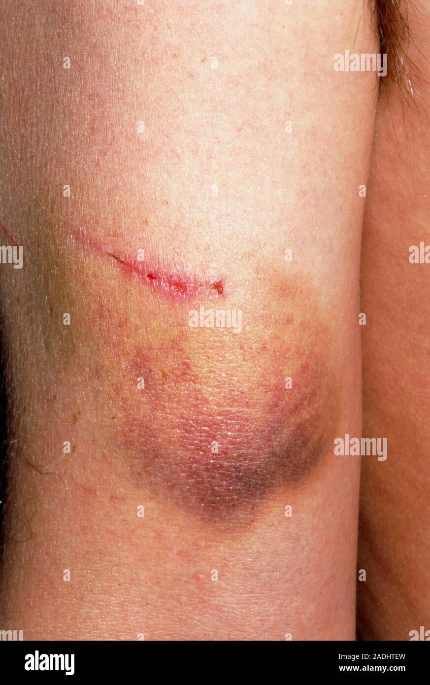 Scratch and bruise (image 5 of 7). Close-up of a scratch and bruise on ...
