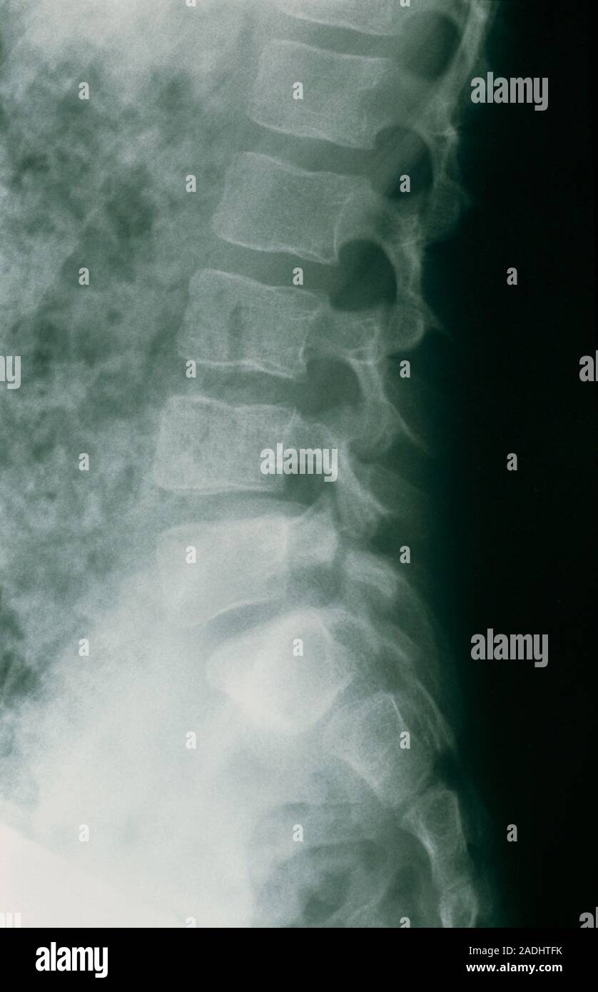 Spondylolisthesis. X-ray of the lower back showing the spine with a ...