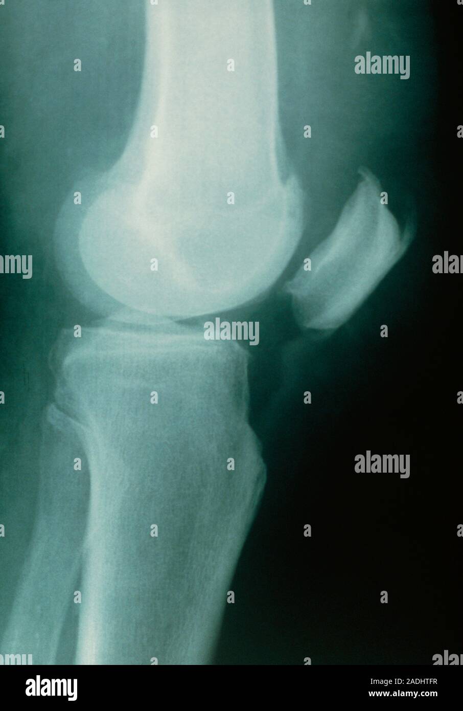 Ruptured patellar tendon. Xray of a knee with a ruptured patellar