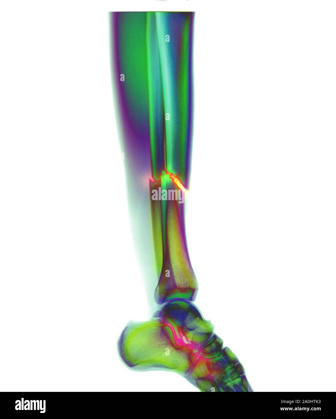 Broken leg. Coloured X-ray showing multiple fractures (centre) to the ...
