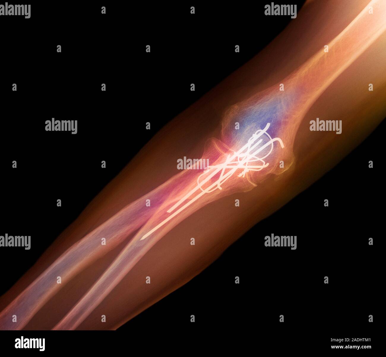 Pinned elbow fracture. Coloured Xray showing metal pins (white) in a