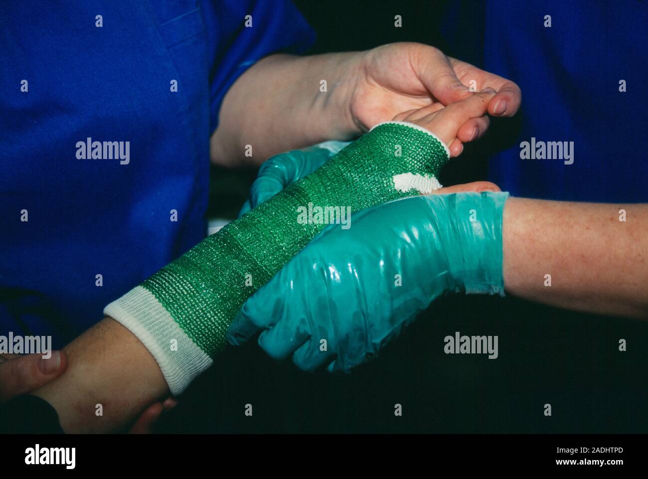 Broken wrist. Hands of orthopaedic nurses applying a fibreglass cast