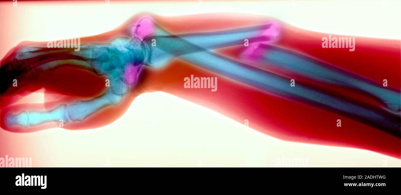 Broken arm and dislocated wrist. Coloured Xray showing a fracture